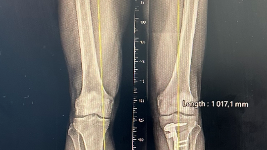 OSTEOTOMIE DOLNÍCH KONČETIN